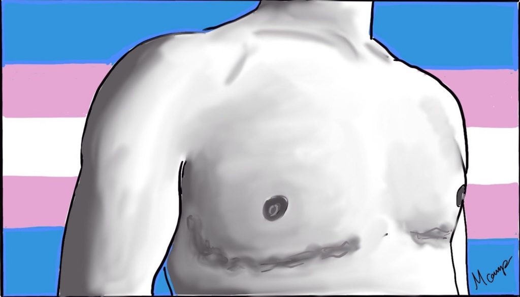 Person with top surgery scars. There is a trans flag in the background